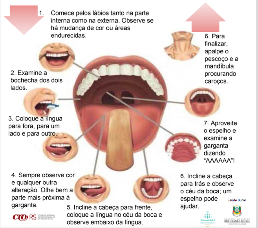 Featured image of post Imagens De Câncer No Céu Da Boca - Estar atento aos sintomas do câncer de boca significa conseguir um diagnóstico mais cedo e aumentar as chances de cura.